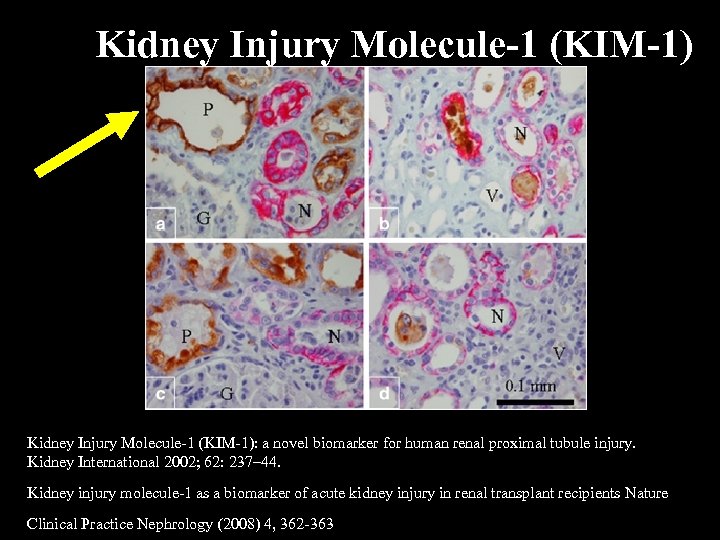 Kidney Injury Molecule-1 (KIM-1): a novel biomarker for human renal proximal tubule injury. Kidney