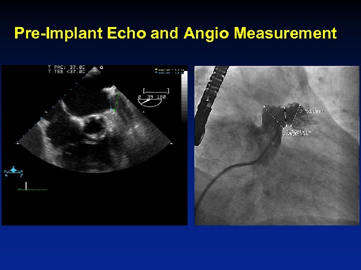 Pre-Implant Echo and Angio Measurement 