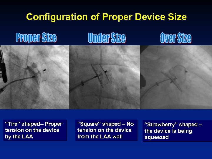 Configuration of Proper Device Size “Tire” shaped-- Proper tension on the device by the