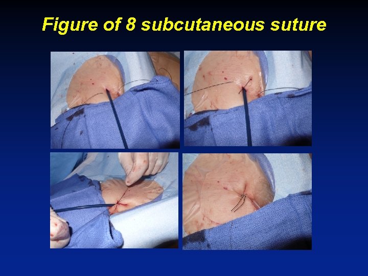Figure of 8 subcutaneous suture 