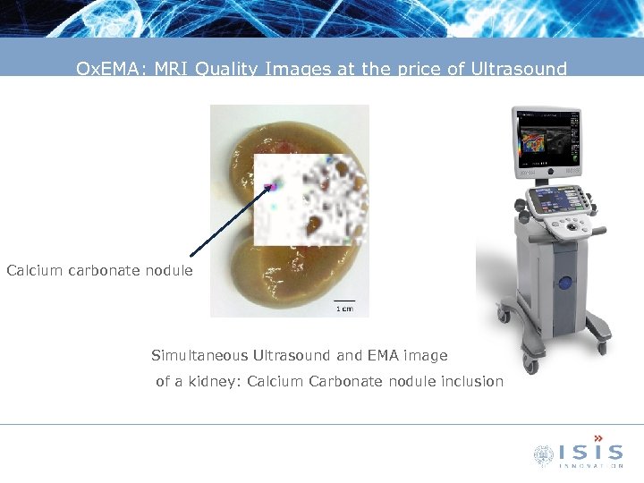 Ox. EMA: MRI Quality Images at the price of Ultrasound Calcium carbonate nodule Simultaneous