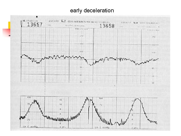 early deceleration 