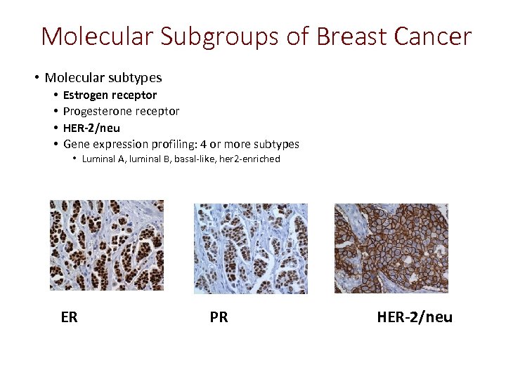 Molecular Subgroups of Breast Cancer • Molecular subtypes • • Estrogen receptor Progesterone receptor