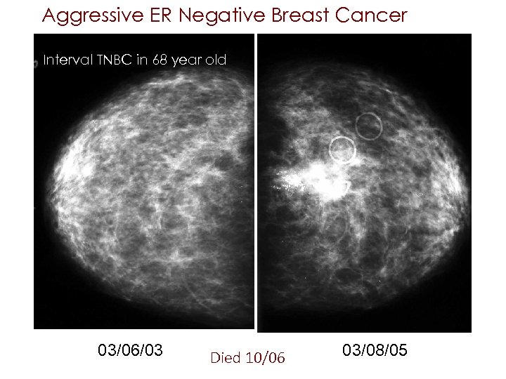 Aggressive ER Negative Breast Cancer Interval TNBC in 68 year old 03/06/03 Died 10/06