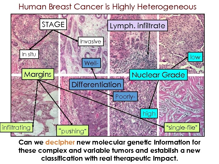 Human Breast Cancer is Highly Heterogeneous STAGE Lymph. infiltrate invasive In situ low Well-