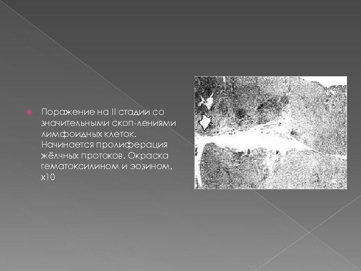  Поражение на II стадии со значительными скоп лениями лимфоидных клеток. Начинается пролиферация жёлчных