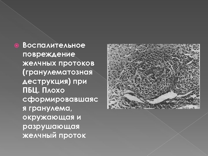  Воспалительное повреждение желчных протоков (гранулематозная деструкция) при ПБЦ. Плохо сформировавшаяс я гранулема, окружающая