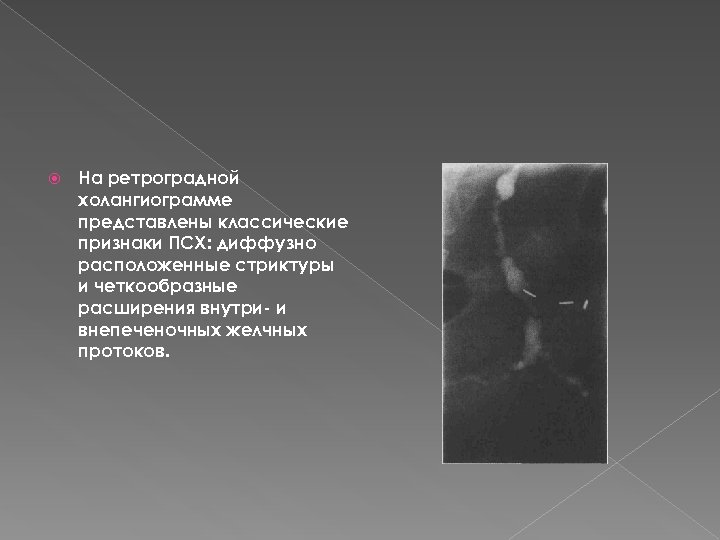  На ретроградной холангиограмме представлены классические признаки ПСХ: диффузно расположенные стриктуры и четкообразные расширения