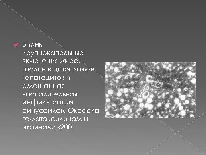  Видны крупнокапельные включения жира, гиалин в цитоплазме гепатоцитов и смешанная воспалительная инфильтрация синусоидов.