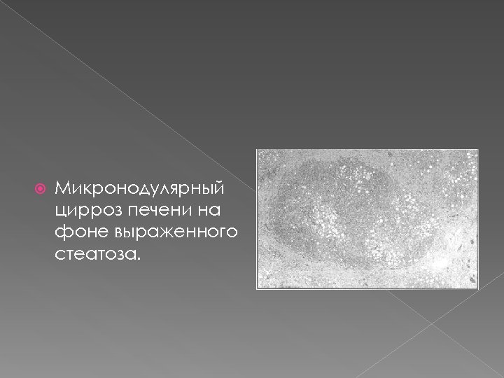  Микронодулярный цирроз печени на фоне выраженного стеатоза. 