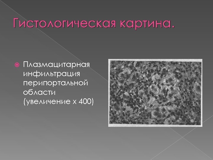 Гистологическая картина. Плазмацитарная инфильтрация перипортальной области (увеличение х 400) 