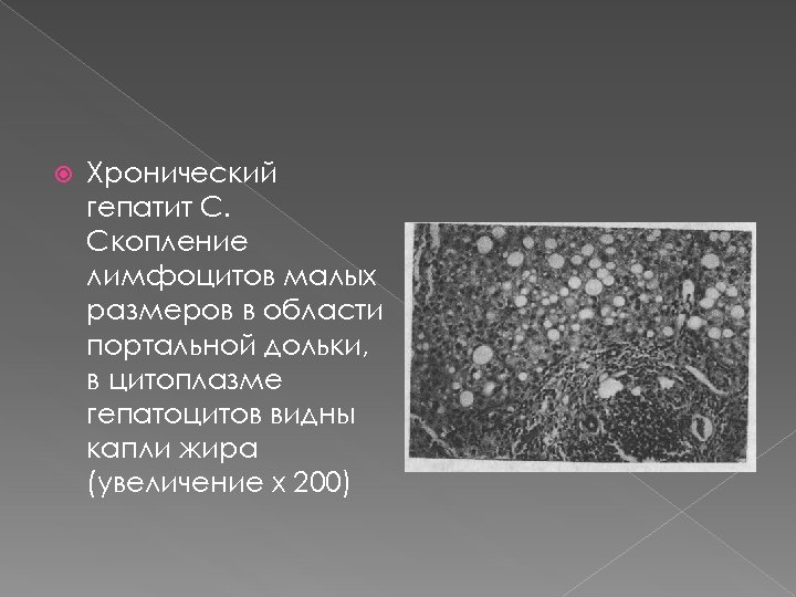  Хронический гепатит С. Скопление лимфоцитов малых размеров в области портальной дольки, в цитоплазме