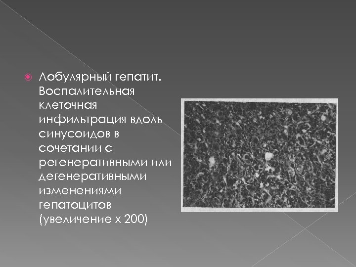 Лобулярный гепатит. Воспалительная клеточная инфильтрация вдоль синусоидов в сочетании с регенеративными или дегенеративными