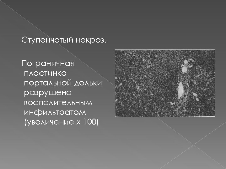 Ступенчатый некроз. Пограничная пластинка портальной дольки разрушена воспалительным инфильтратом (увеличение х 100) 