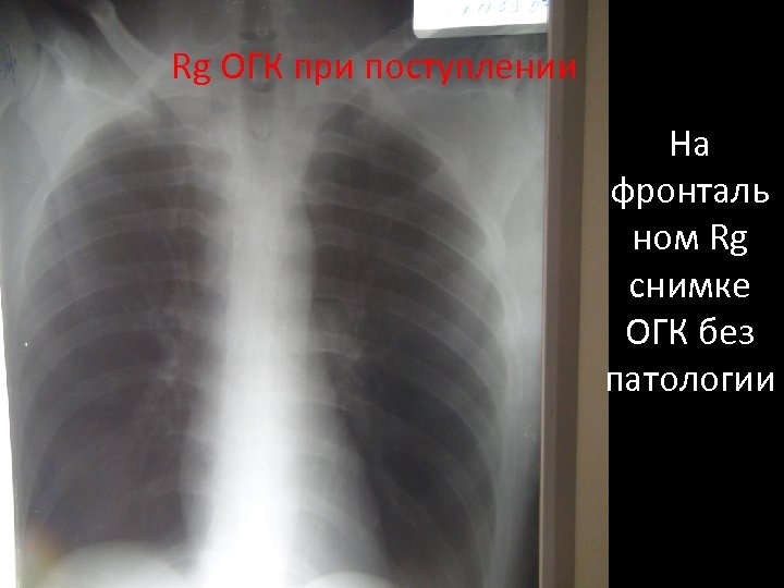 Rg ОГК при поступлении На фронталь ном Rg снимке ОГК без патологии 