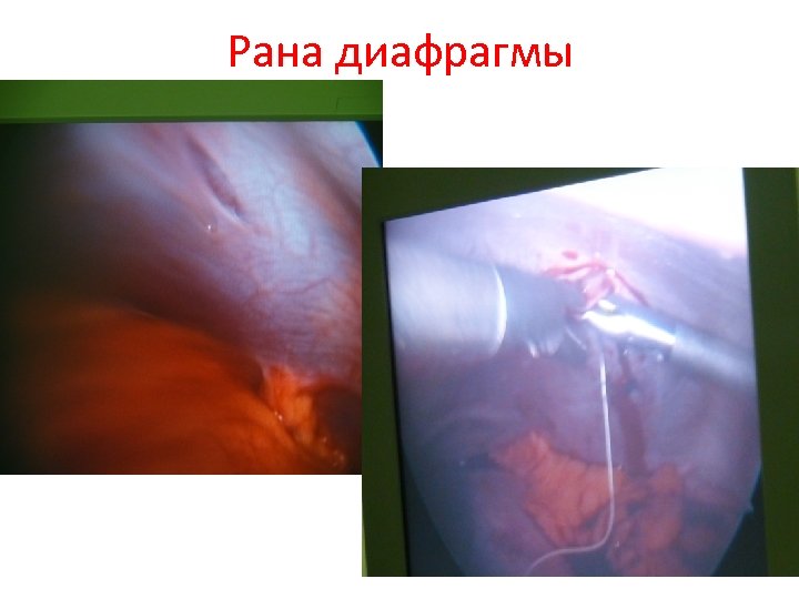 Рана диафрагмы 