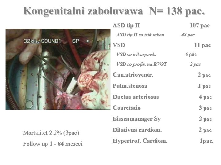 Kongenitalni zaboluvawa N= 138 pac. ASD tip II so trik rekon VSD so trikusp.