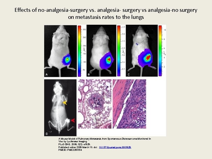 Effects of no-analgesia-surgery vs. analgesia- surgery vs analgesia-no surgery on metastasis rates to the