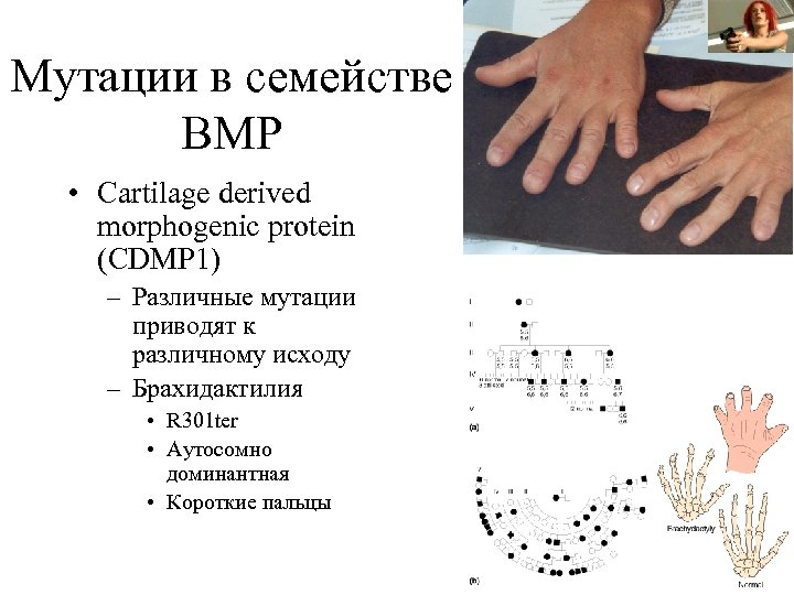 Мутации в семействе BMP • Cartilage derived morphogenic protein (CDMP 1) – Различные мутации