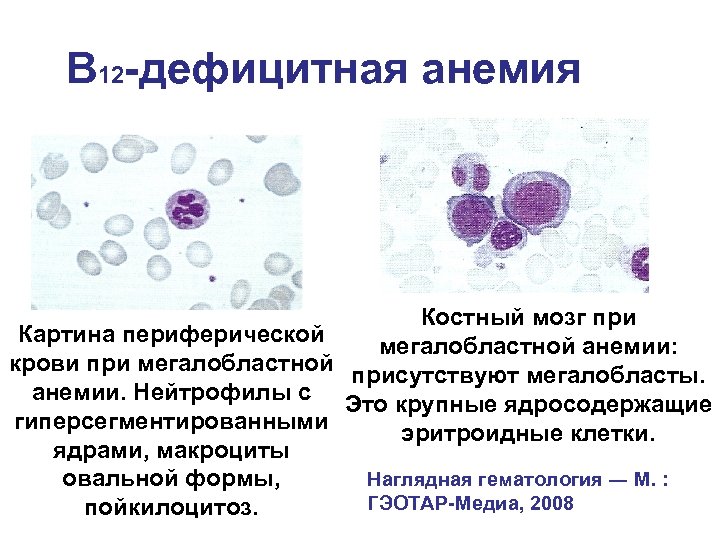 Изменение клеток крови. Картина костного мозга при в12 дефицитной анемии. Картина периферической крови при в12 дефицитной. Картина крови при в12-фолиеводефицитной анемии. Анемия при которой в периферической крови появляются мегалобласты.