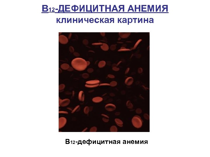 В 12 -ДЕФИЦИТНАЯ АНЕМИЯ клиническая картина В 12 -дефицитная анемия 