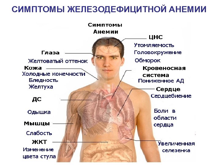 СИМПТОМЫ ЖЕЛЕЗОДЕФИЦИТНОЙ АНЕМИИ 