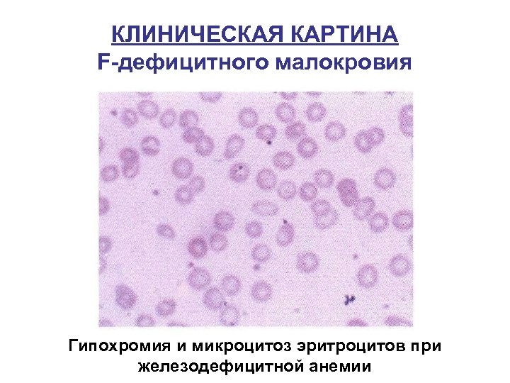 КЛИНИЧЕСКАЯ КАРТИНА F-дефицитного малокровия Гипохромия и микроцитоз эритроцитов при железодефицитной анемии 