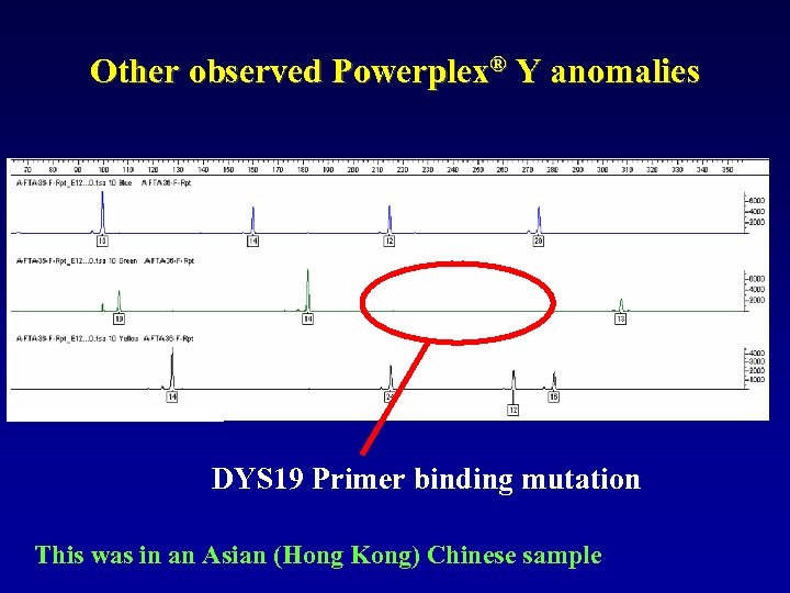 Other observed Powerplex® Y anomalies DYS 19 Primer binding mutation This was in an