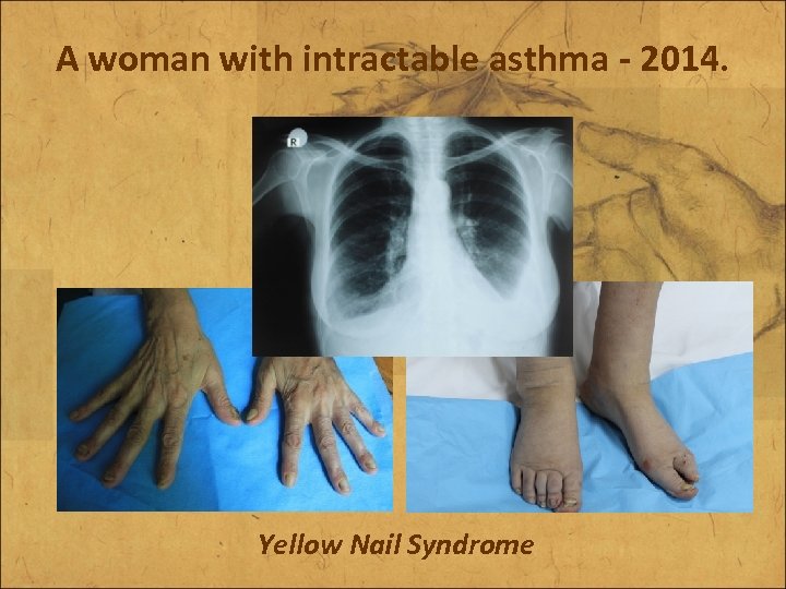 A woman with intractable asthma - 2014. Yellow Nail Syndrome 