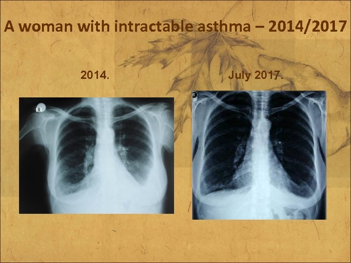 A woman with intractable asthma – 2014/2017 2014. July 2017. 