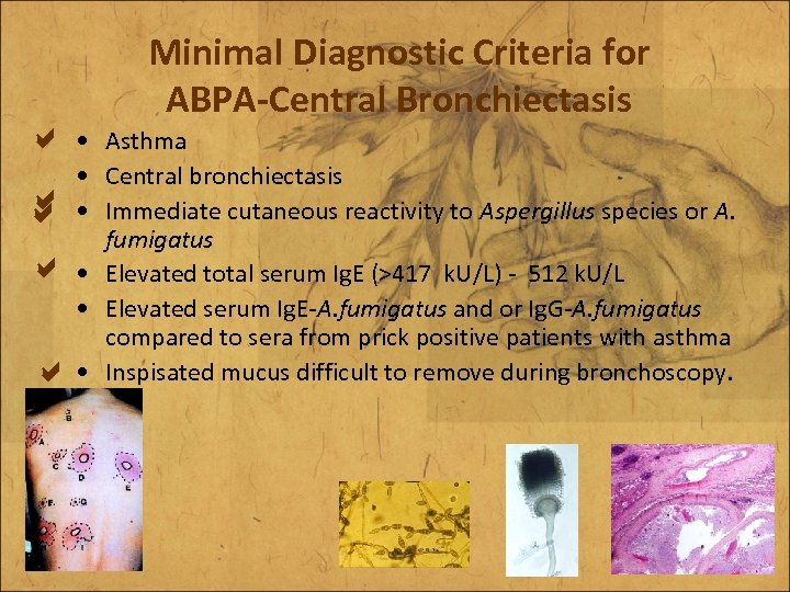  Minimal Diagnostic Criteria for ABPA-Central Bronchiectasis • Asthma • Central bronchiectasis • Immediate