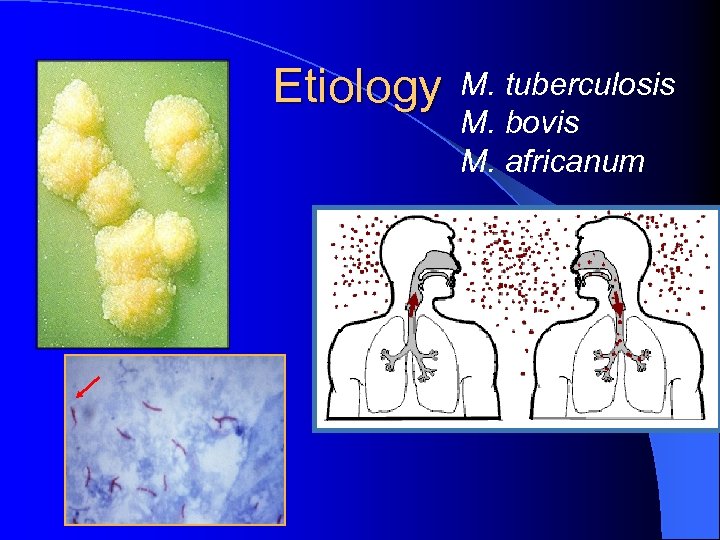 Etiology M. tuberculosis M. bovis M. africanum 