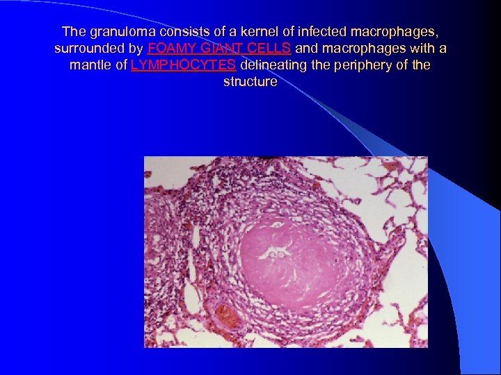 The granuloma consists of a kernel of infected macrophages, surrounded by FOAMY GIANT CELLS