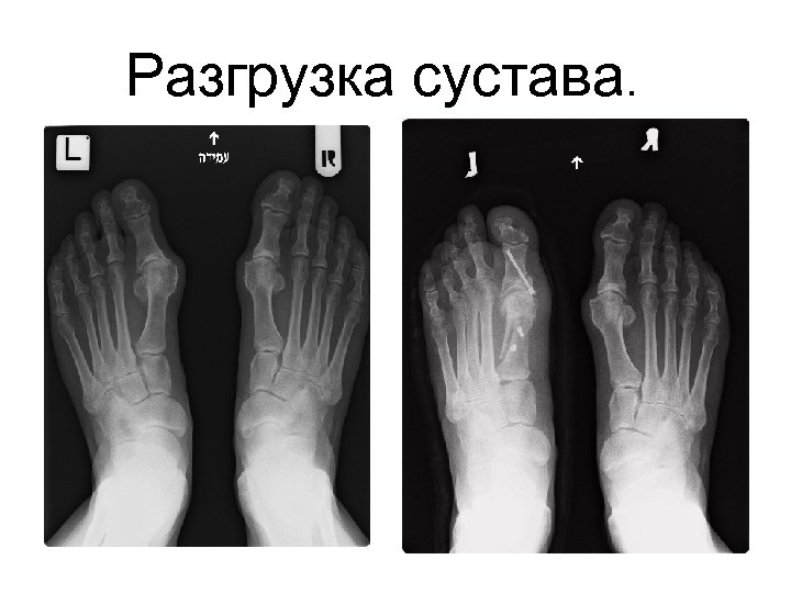 Разгрузка сустава. 