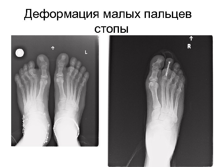 Деформация малых пальцев стопы 