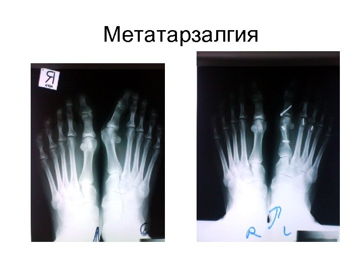 Метатарзалгия 