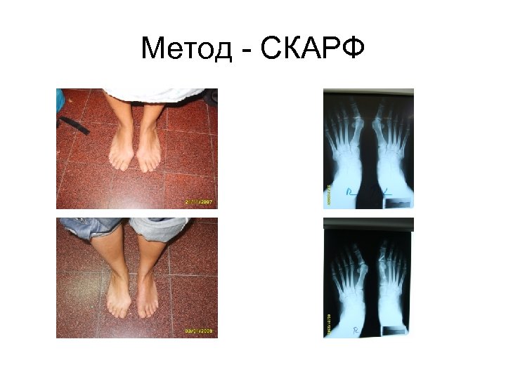 Метод - СКАРФ 