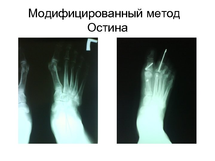 Модифицированный метод Остина 