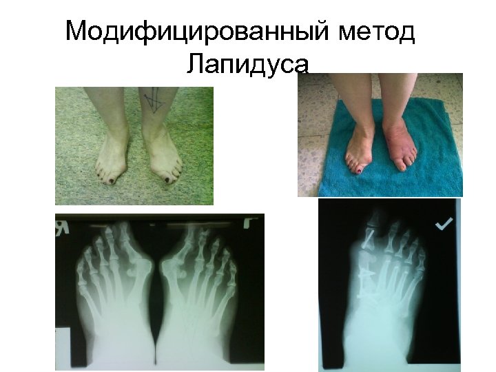 Модифицированный метод Лапидуса 