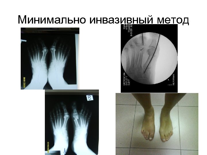 Минимально инвазивный метод 