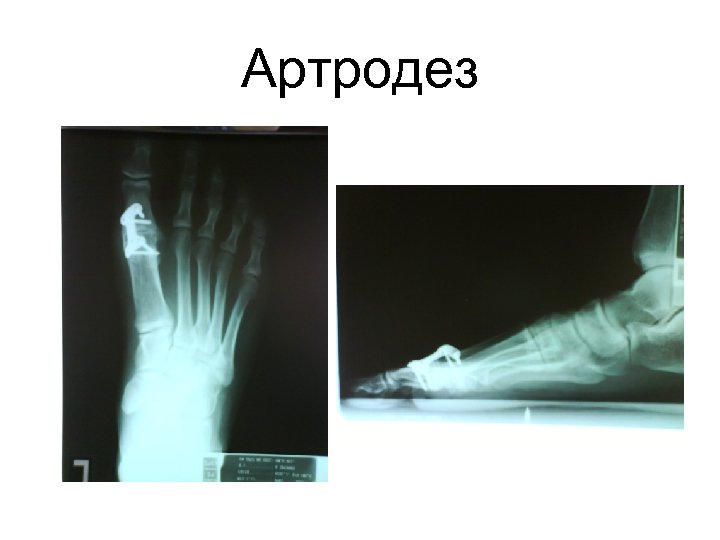 Артродез 