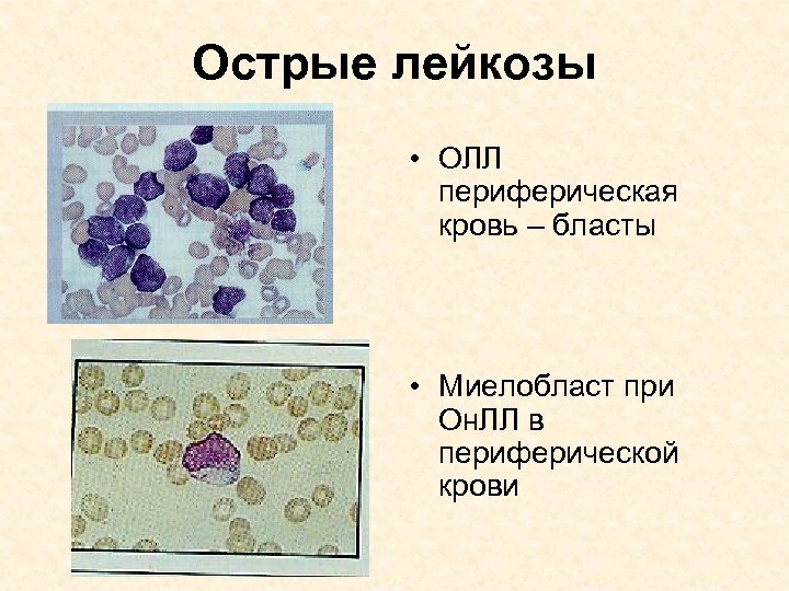 Бласты в крови картинки