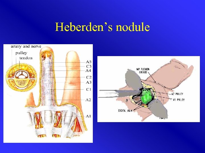 Heberden’s nodule 