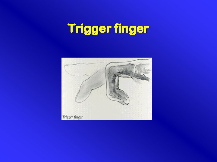 Trigger finger 