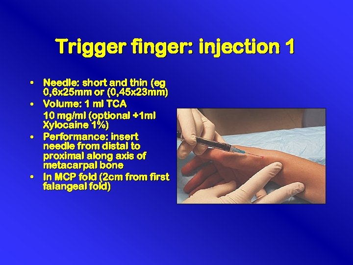 Trigger finger: injection 1 • Needle: short and thin (eg 0, 6 x 25