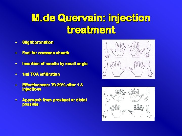 M. de Quervain: injection treatment • Slight pronation • Feel for common sheath •