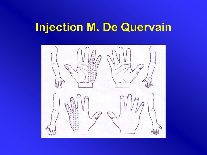 Injection M. De Quervain 