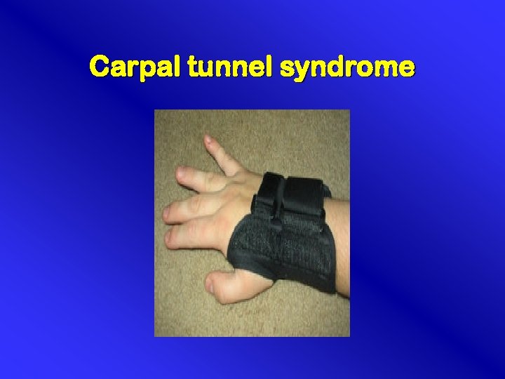 Carpal tunnel syndrome 