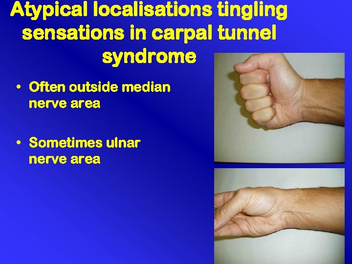 Atypical localisations tingling sensations in carpal tunnel syndrome • Often outside median nerve area