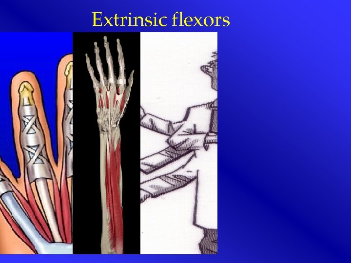 Extrinsic flexors 